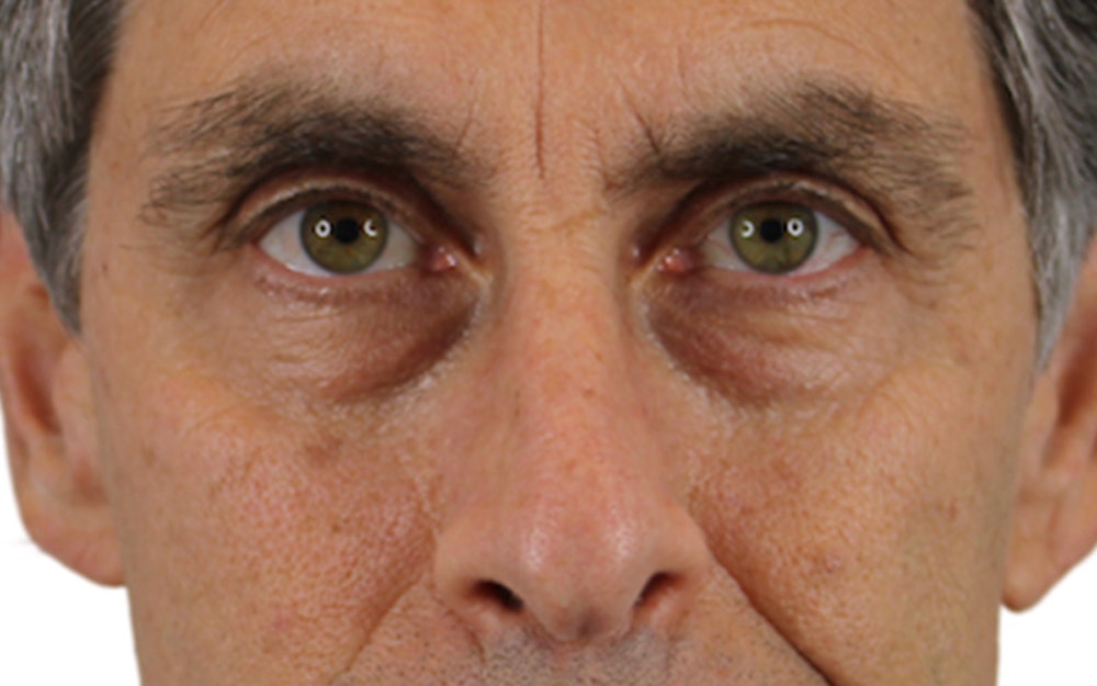 Blepharoplasty Before & After Gallery - Patient 53828309 - Image 1