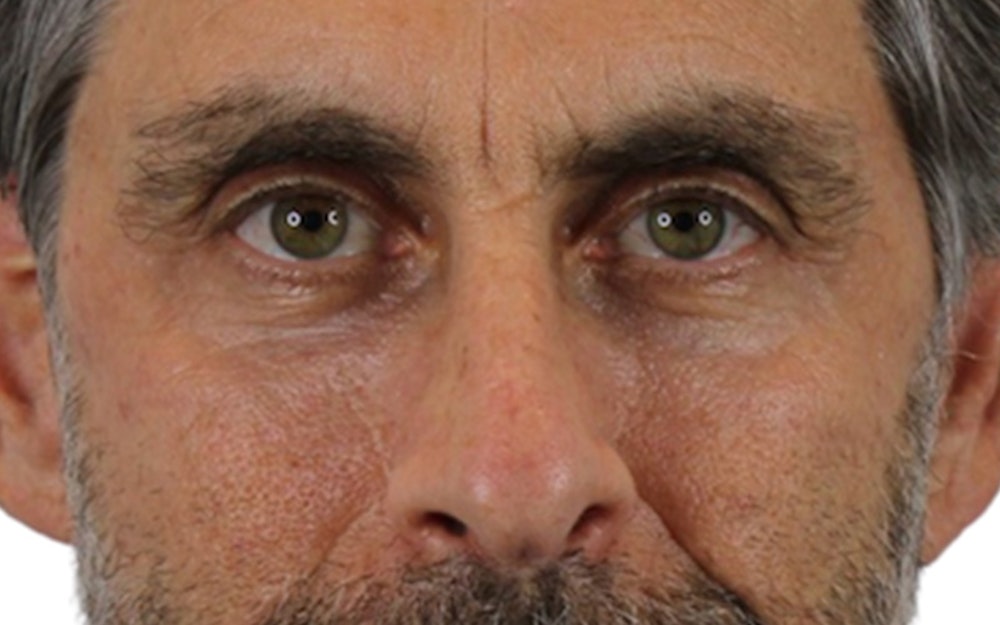 Blepharoplasty Before & After Gallery - Patient 53828309 - Image 2