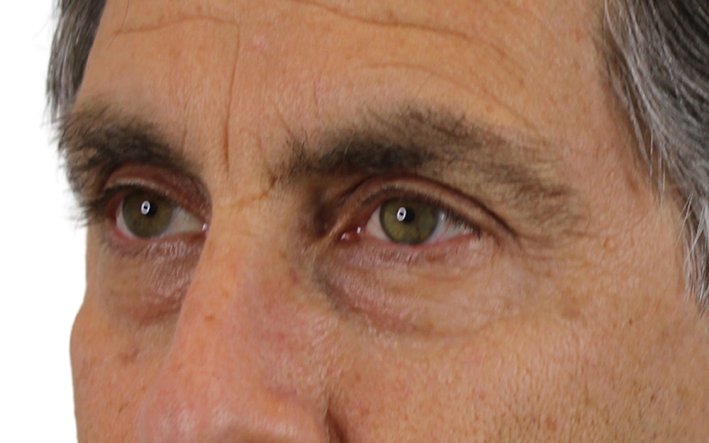 Blepharoplasty Before & After Gallery - Patient 53828309 - Image 3