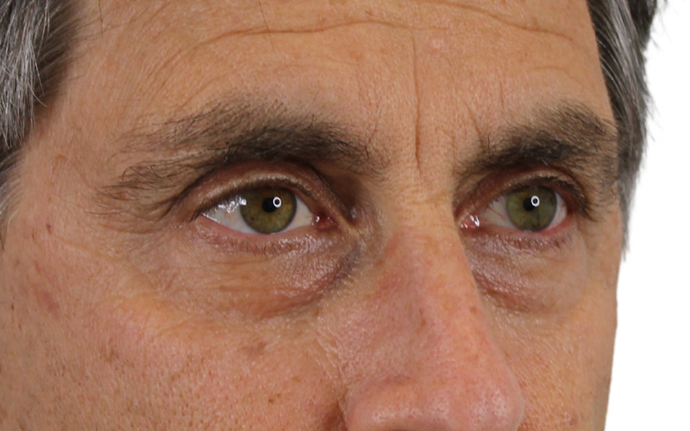 Blepharoplasty Before & After Gallery - Patient 53828309 - Image 5