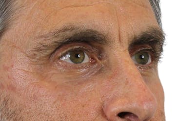 Blepharoplasty Before & After Gallery - Patient 53828309 - Image 6