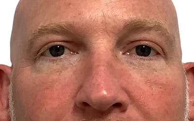 Blepharoplasty Before & After Gallery - Patient 24397414 - Image 2