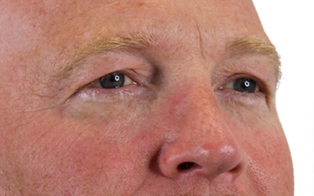 Blepharoplasty Before & After Gallery - Patient 24397414 - Image 3