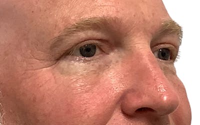 Blepharoplasty Before & After Gallery - Patient 24397414 - Image 4