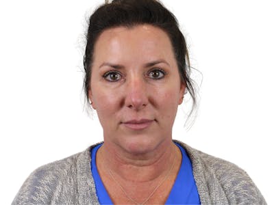 Deep Plane Facelift Before & After Gallery - Patient 147538133 - Image 1