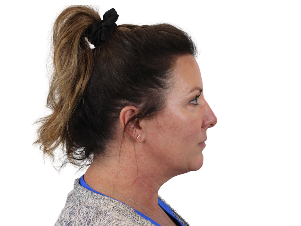 Deep Plane Facelift Before & After Gallery - Patient 147538133 - Image 5