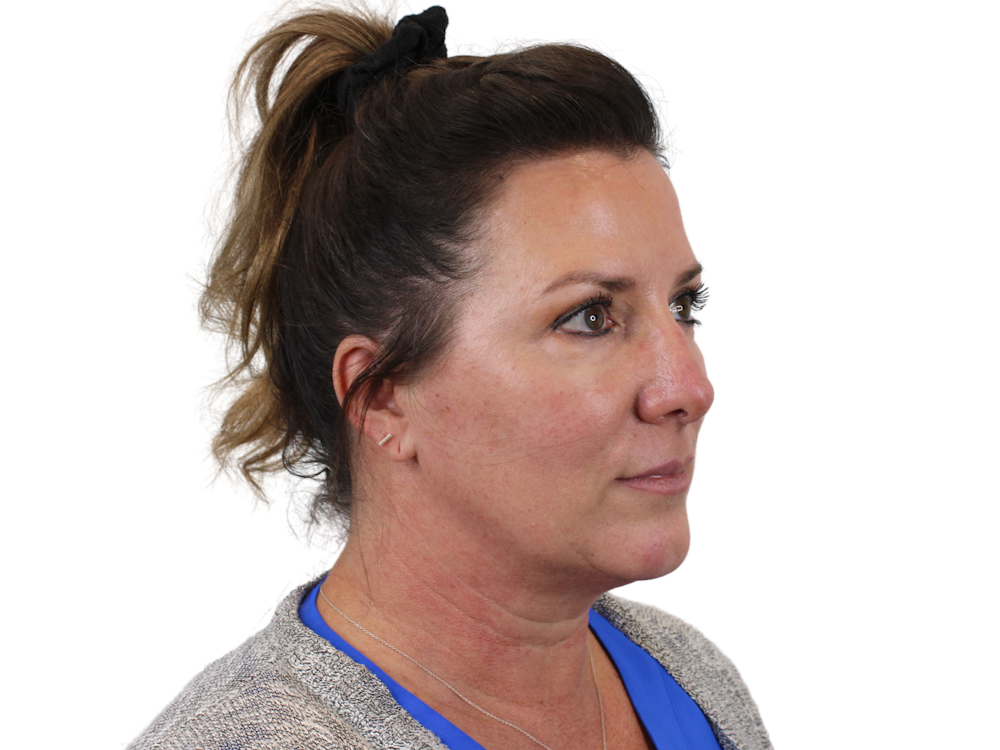 Deep Plane Facelift Before & After Gallery - Patient 147538133 - Image 7
