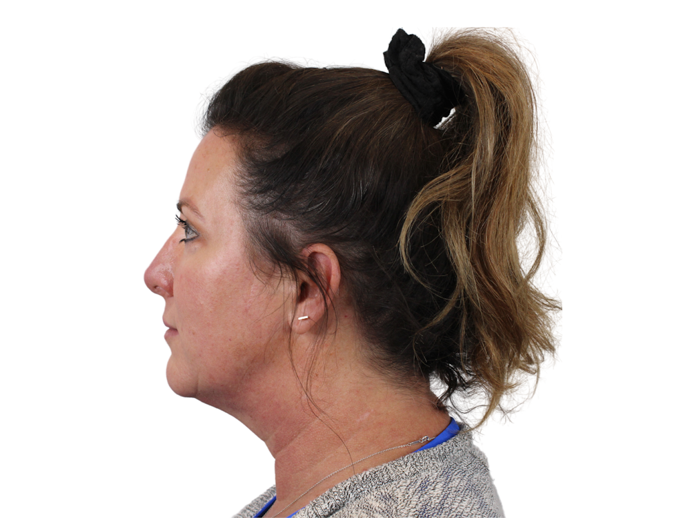 Deep Plane Facelift Before & After Gallery - Patient 147538133 - Image 9