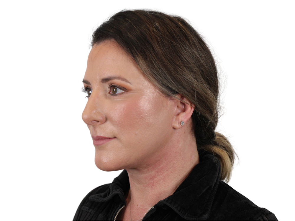 Deep Plane Facelift Before & After Gallery - Patient 147538133 - Image 4
