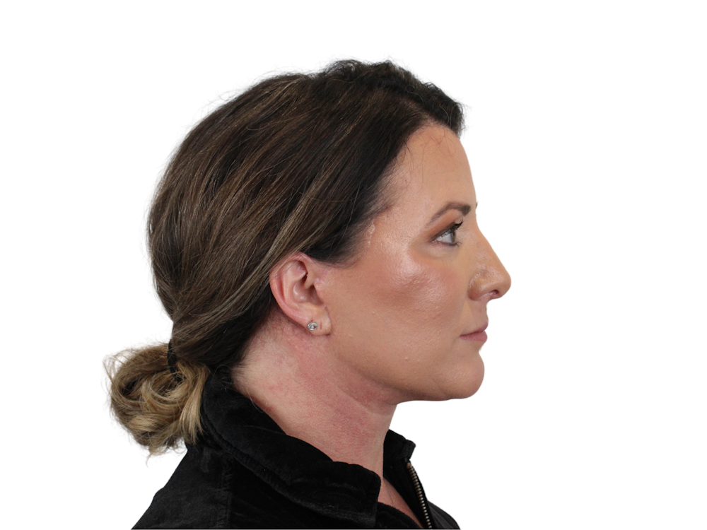 Deep Neck Lift Before & After Gallery - Patient 147538134 - Image 6