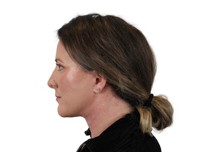 Deep Neck Lift Before & After Gallery - Patient 147538134 - Image 10
