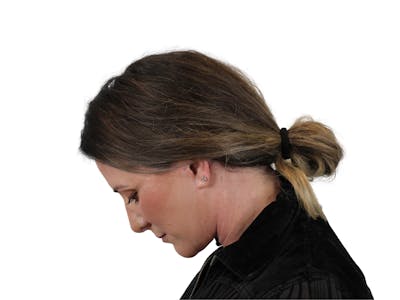 Deep Plane Facelift Before & After Gallery - Patient 147538133 - Image 12