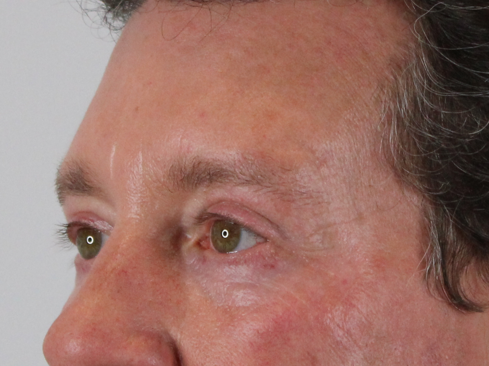 Blepharoplasty Before & After Gallery - Patient 147538319 - Image 6