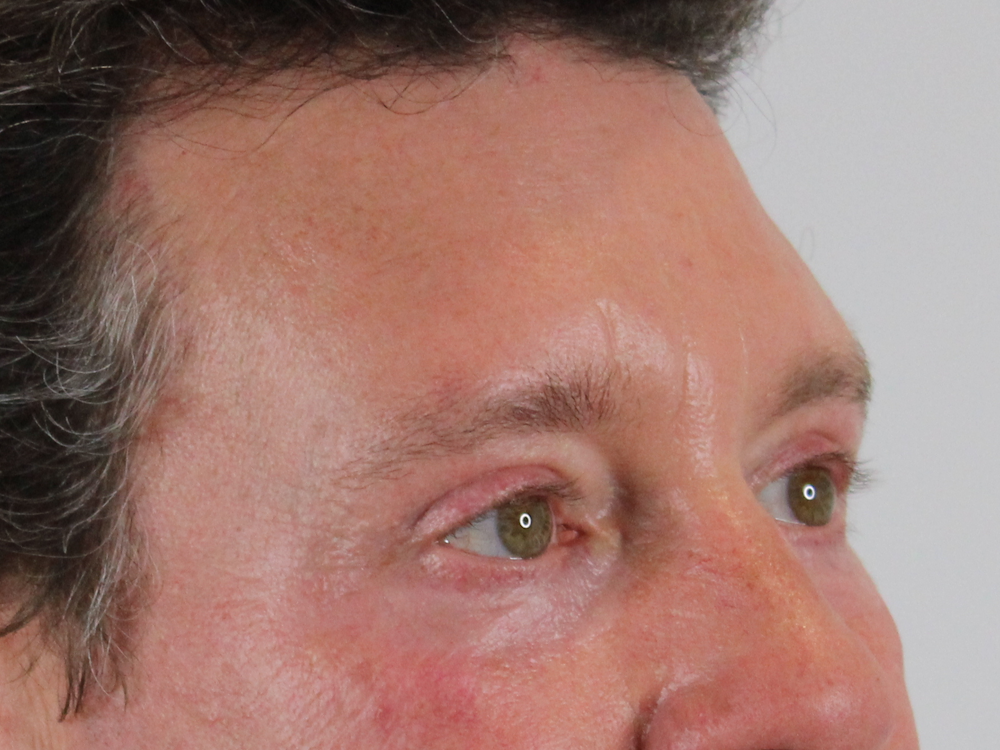 Blepharoplasty Before & After Gallery - Patient 147538319 - Image 4