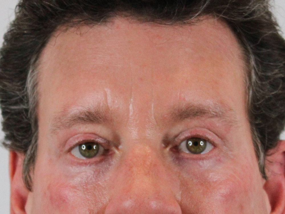 Blepharoplasty Before & After Gallery - Patient 147538319 - Image 2