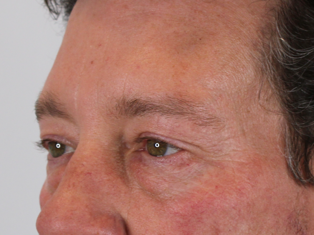 Blepharoplasty Before & After Gallery - Patient 147538319 - Image 5