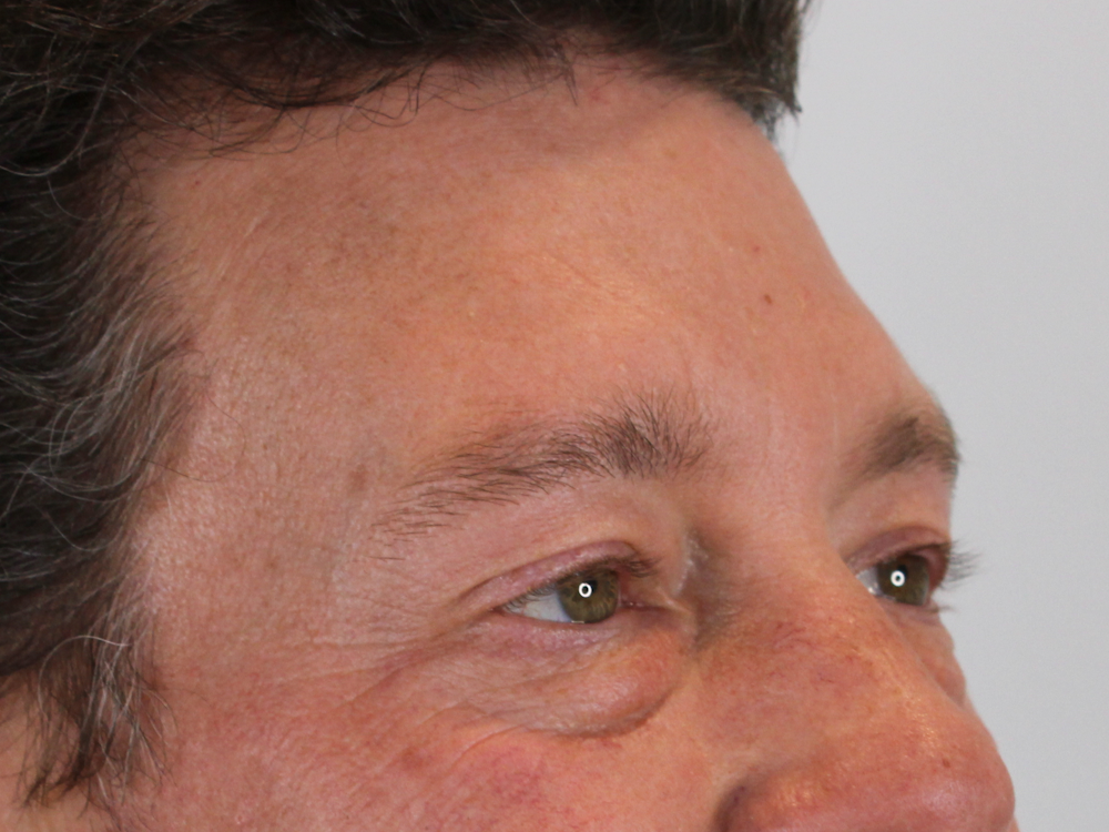 Blepharoplasty Before & After Gallery - Patient 147538319 - Image 3