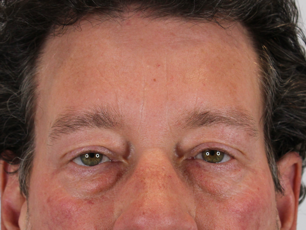 Blepharoplasty Before & After Gallery - Patient 147538319 - Image 1