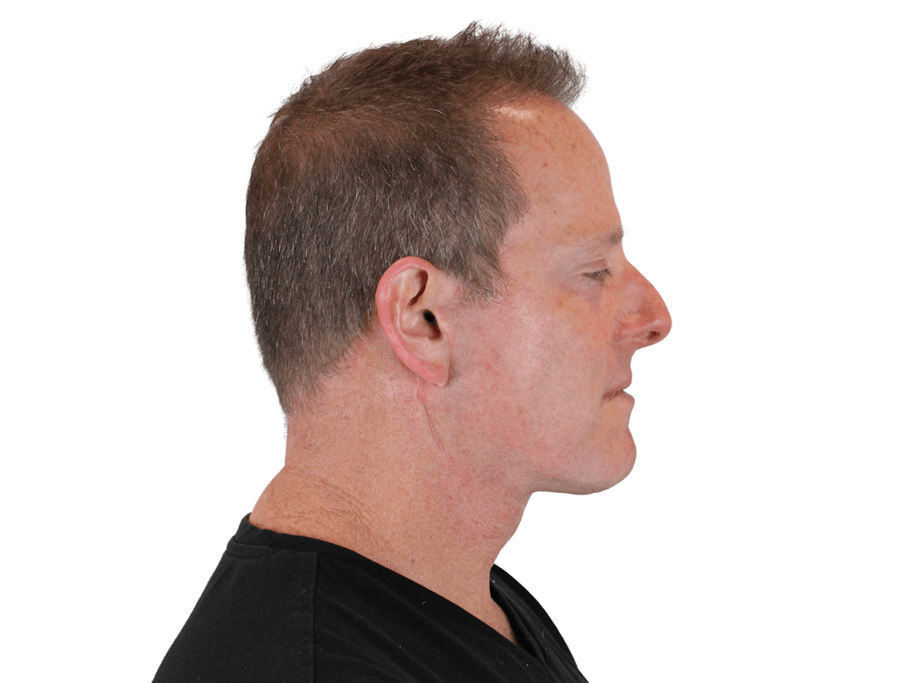 Deep Neck Lift Before & After Gallery - Patient 148352223 - Image 8