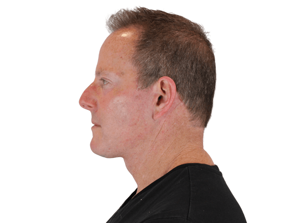 Deep Neck Lift Before & After Gallery - Patient 148352223 - Image 10