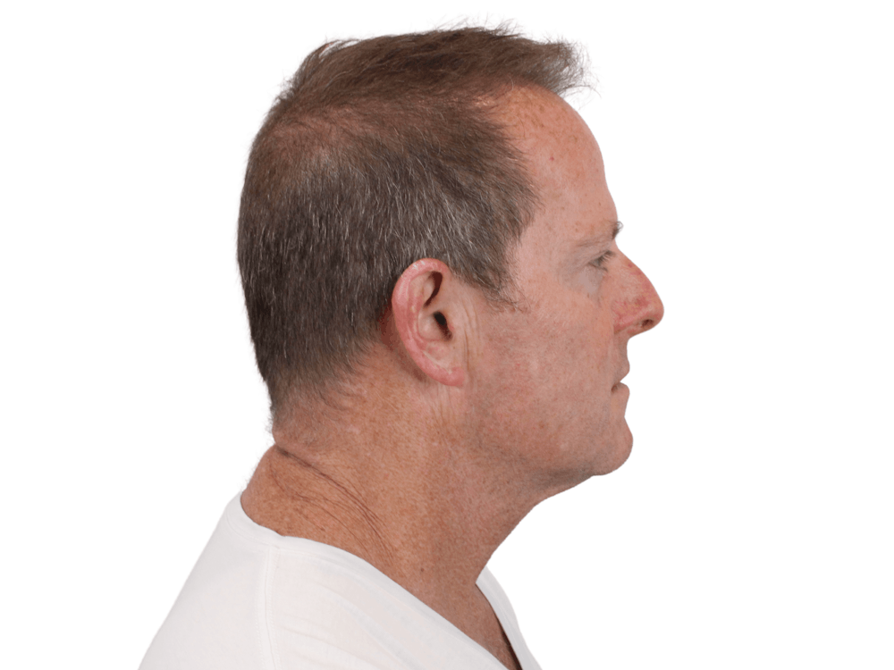 Deep Plane Facelift Before & After Gallery - Patient 148352204 - Image 7