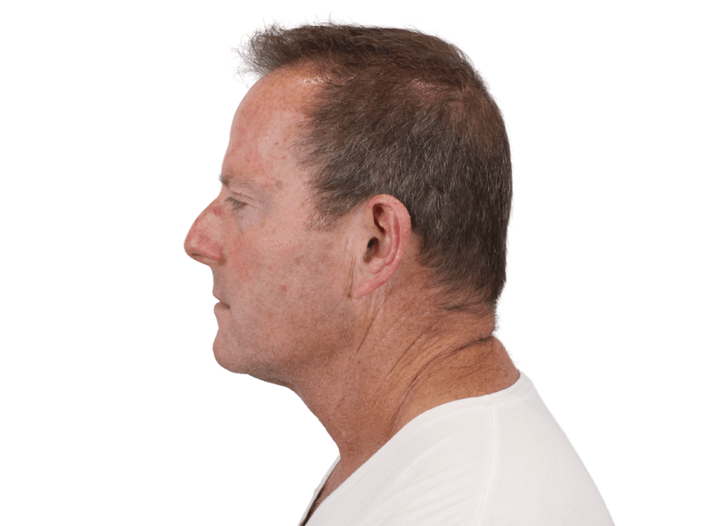 Deep Neck Lift Before & After Gallery - Patient 148352223 - Image 9
