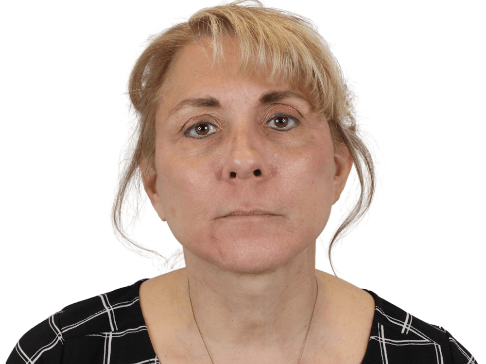 Deep Plane Facelift Before & After Gallery - Patient 148352203 - Image 2