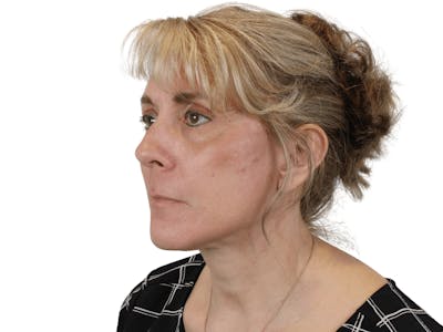 Deep Neck Lift Before & After Gallery - Patient 148352222 - Image 4