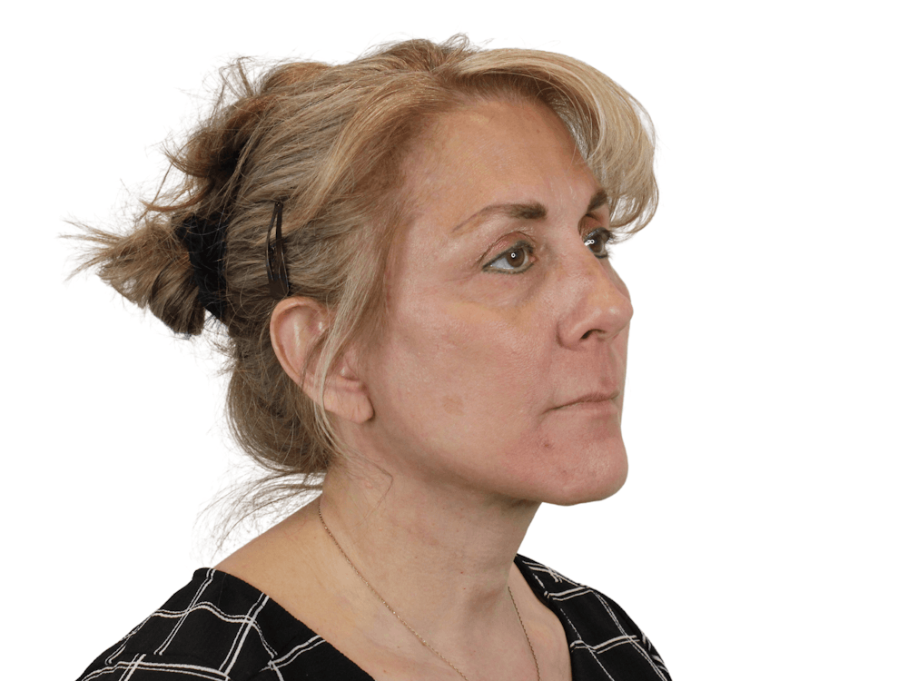 Deep Neck Lift Before & After Gallery - Patient 148352222 - Image 6