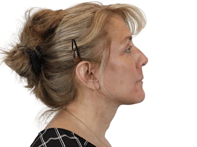 Deep Plane Facelift Before & After Gallery - Patient 148352203 - Image 8