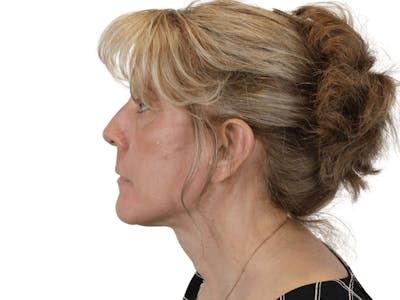 Deep Neck Lift Before & After Gallery - Patient 148352222 - Image 10
