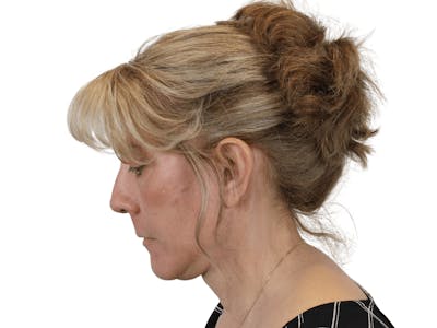 Deep Plane Facelift Before & After Gallery - Patient 148352203 - Image 12