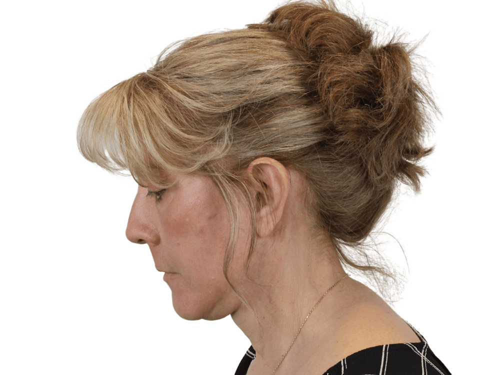 Deep Neck Lift Before & After Gallery - Patient 148352222 - Image 12