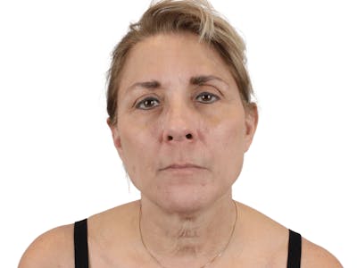 Deep Neck Lift Before & After Gallery - Patient 148352222 - Image 1