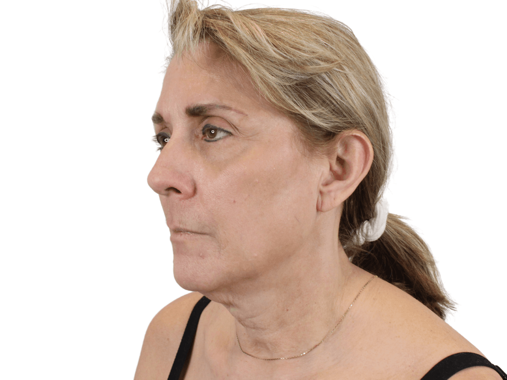 Deep Plane Facelift Before & After Gallery - Patient 148352203 - Image 3