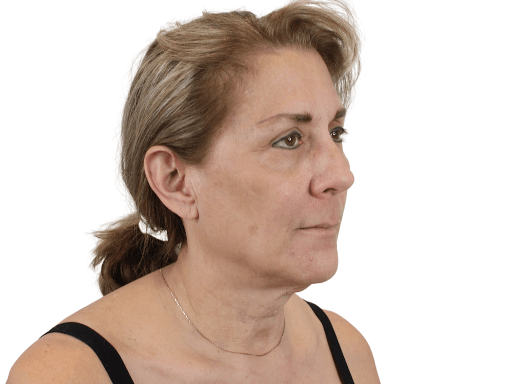 Deep Plane Facelift Before & After Gallery - Patient 148352203 - Image 5