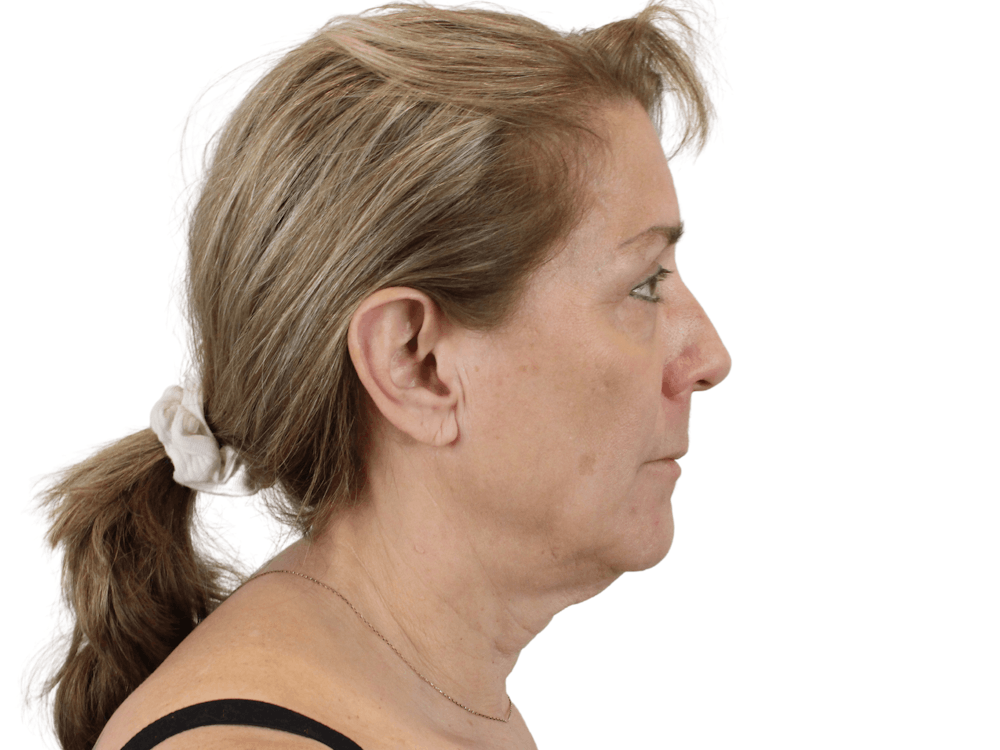 Deep Plane Facelift Before & After Gallery - Patient 148352203 - Image 7