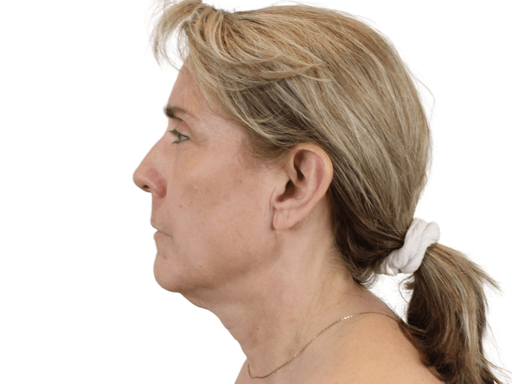 Deep Plane Facelift Before & After Gallery - Patient 148352203 - Image 9
