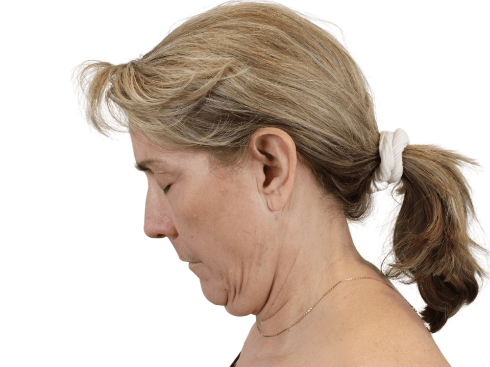 Deep Plane Facelift Before & After Gallery - Patient 148352203 - Image 11