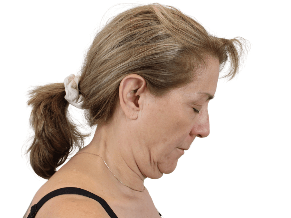 Deep Plane Facelift Before & After Gallery - Patient 148352203 - Image 13