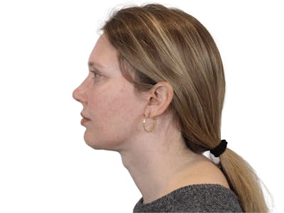 Deep Plane Facelift Before & After Gallery - Patient 148352202 - Image 4