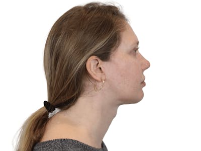Deep Plane Facelift Before & After Gallery - Patient 148352202 - Image 6