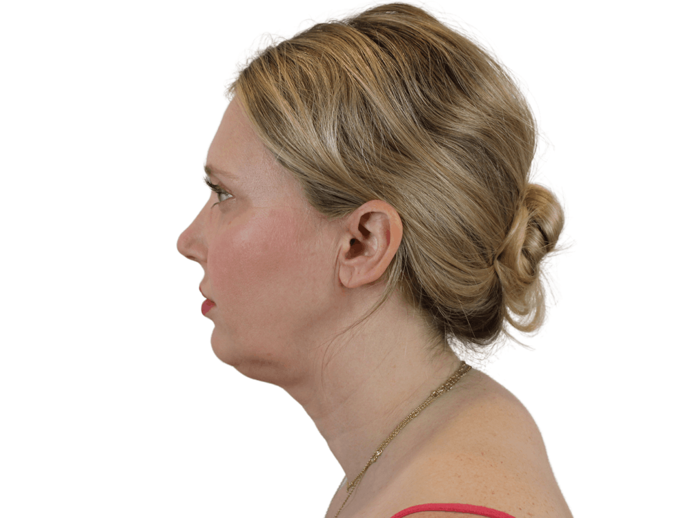 Deep Plane Facelift Before & After Gallery - Patient 148352202 - Image 3
