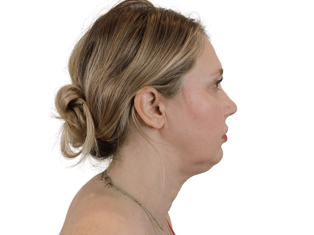 Deep Neck Lift Before & After Gallery - Patient 148352221 - Image 5