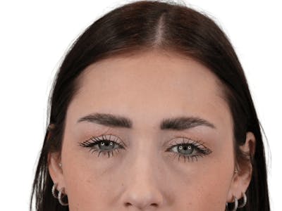 BOTOX  Before & After Gallery - Patient 148367904 - Image 2
