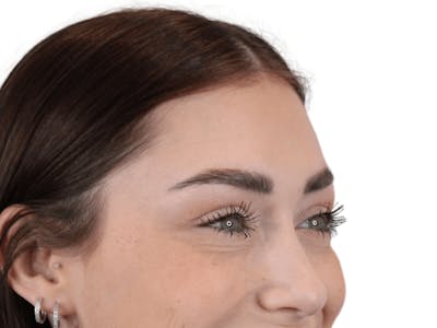 BOTOX  Before & After Gallery - Patient 148367904 - Image 4