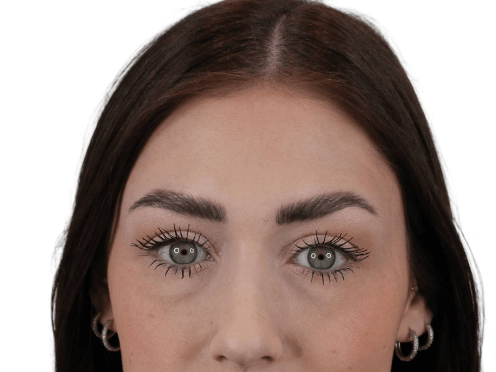 BOTOX  Before & After Gallery - Patient 148367904 - Image 6