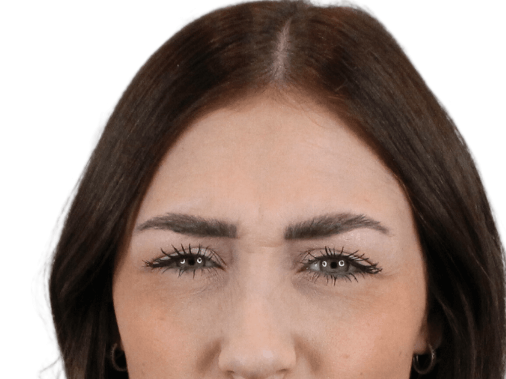 BOTOX  Before & After Gallery - Patient 148367904 - Image 1