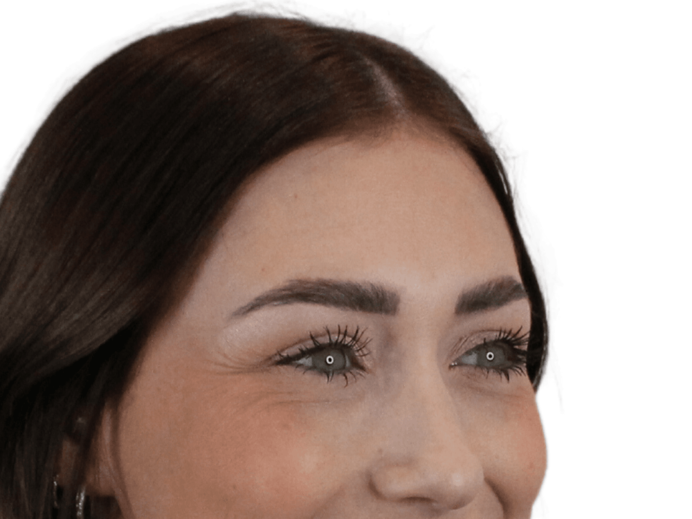 BOTOX  Before & After Gallery - Patient 148367904 - Image 3