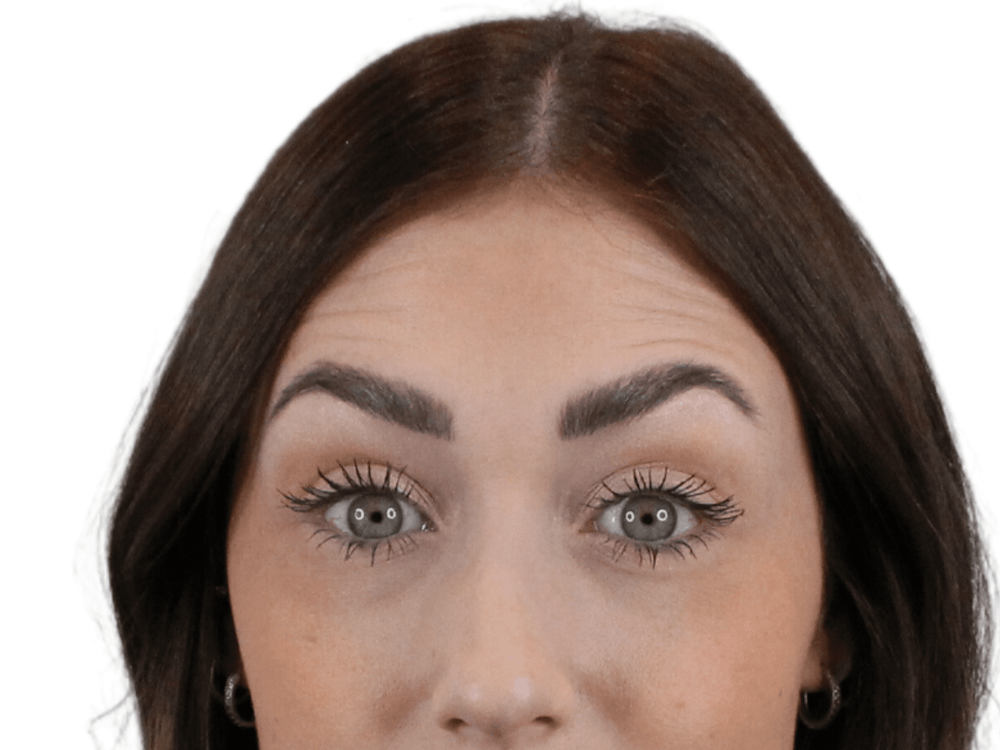 BOTOX  Before & After Gallery - Patient 148367904 - Image 5